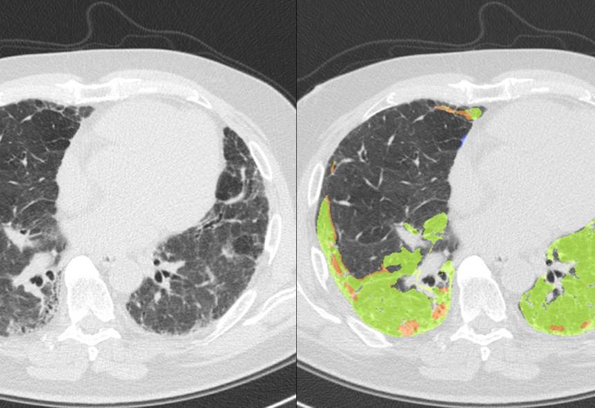 segments-of-the-lungs-on-the-ct-scan.jpg