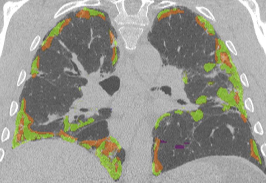 imbios-lung-texture-analysis.jpeg